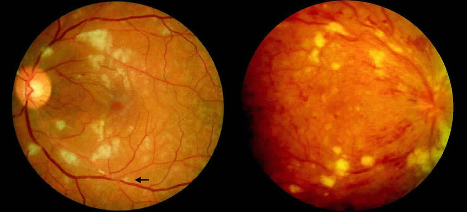 Hvordan hepatitis B påvirker dine øjne