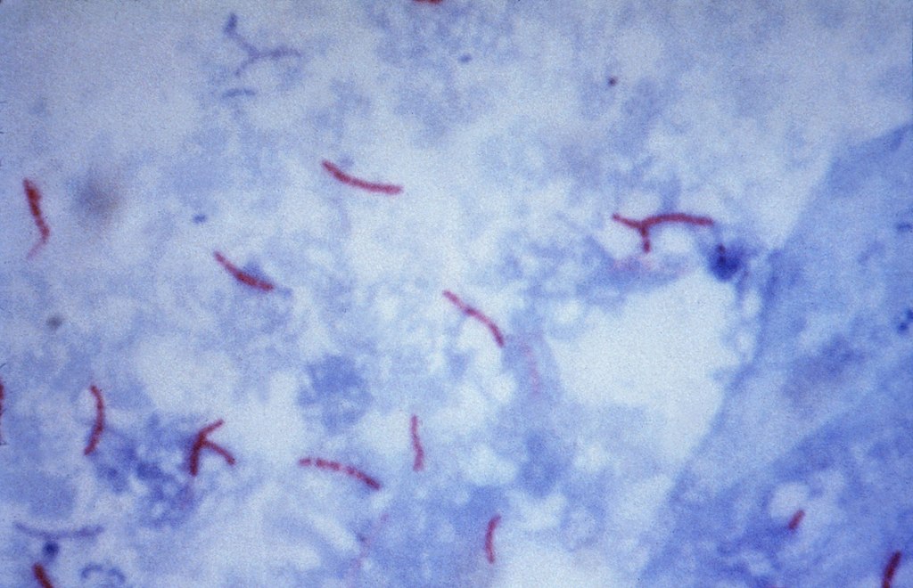 Mycobacterium tuberculosis Ziehl-Neelsen plet 02.jpg