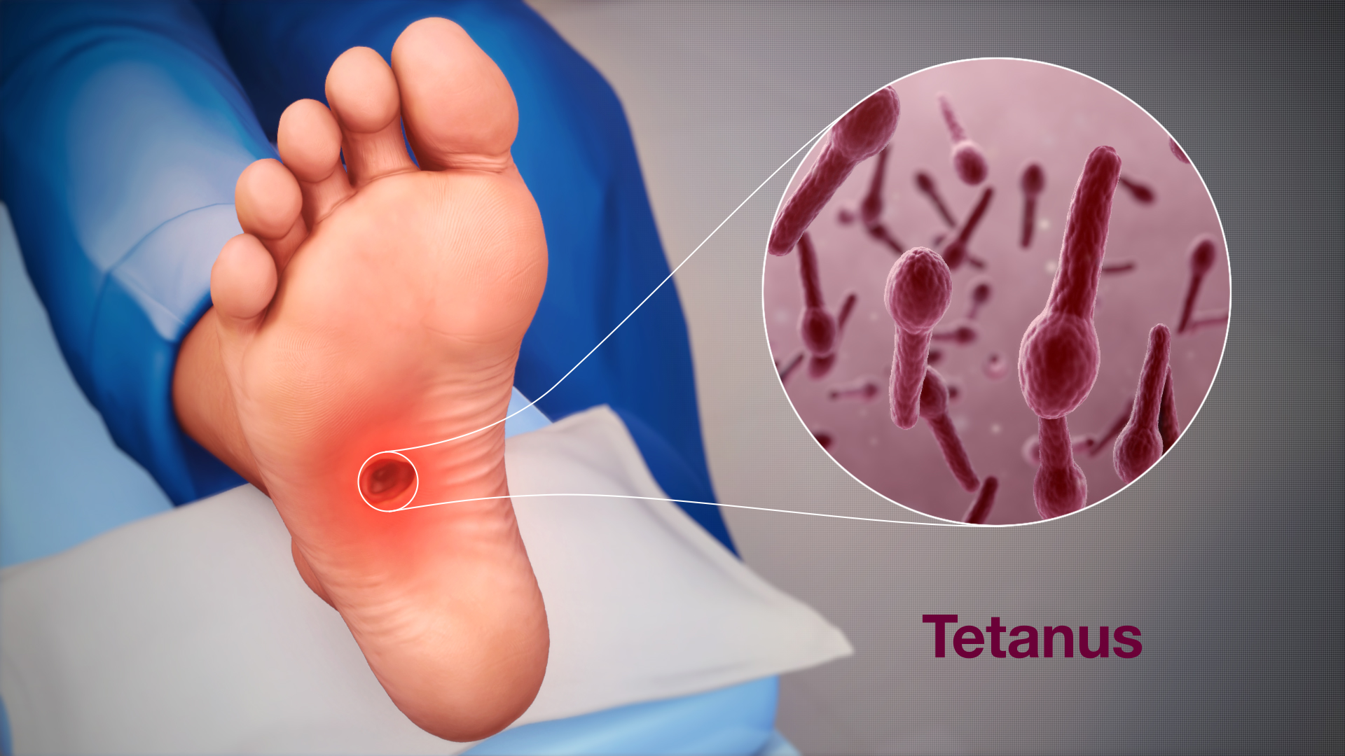 Tetanus: symptomer, årsager og behandling