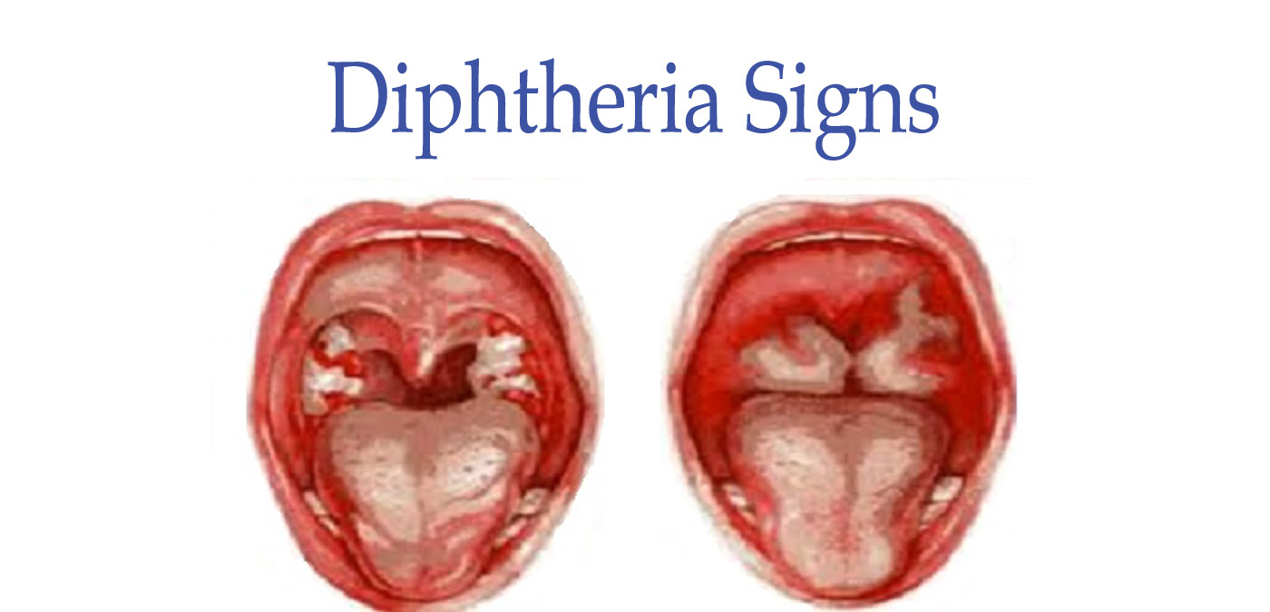 Difteri: årsager, symptomer og behandling