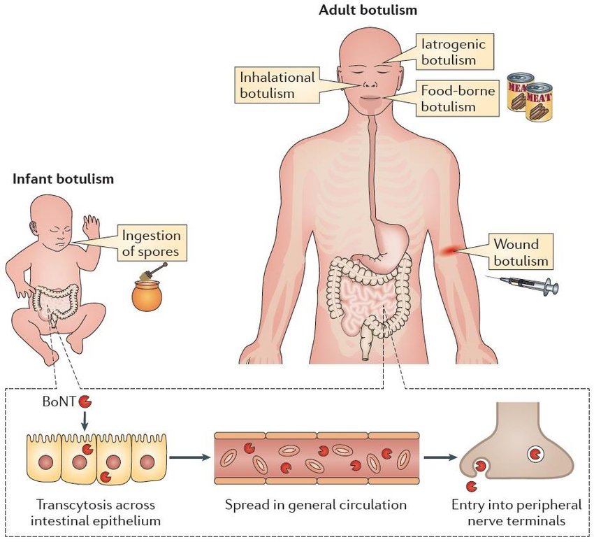 https://www.researchgate.net/profile/Cedric_Woudstra/publication/304792202/figure/fig2/AS:380429820547074@1467712945210/Human-form-of-botulism-Intoxination-due-to-consumption-of-food-contaminated- med.png