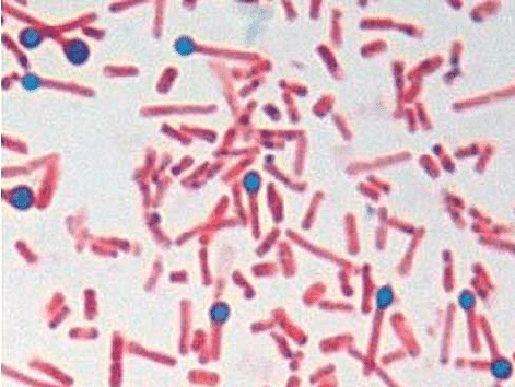 en.  Sporer og bakterier af Clostridium tetani med en typisk tromlepindeform isoleret fra skorpen af ​​dehornsår i tilfælde 1 (gramfarvning-1000x). 