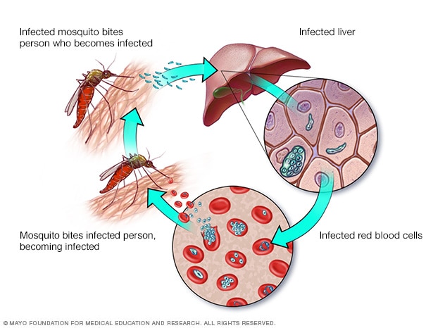 Malaria: årsager, symptomer og behandling
