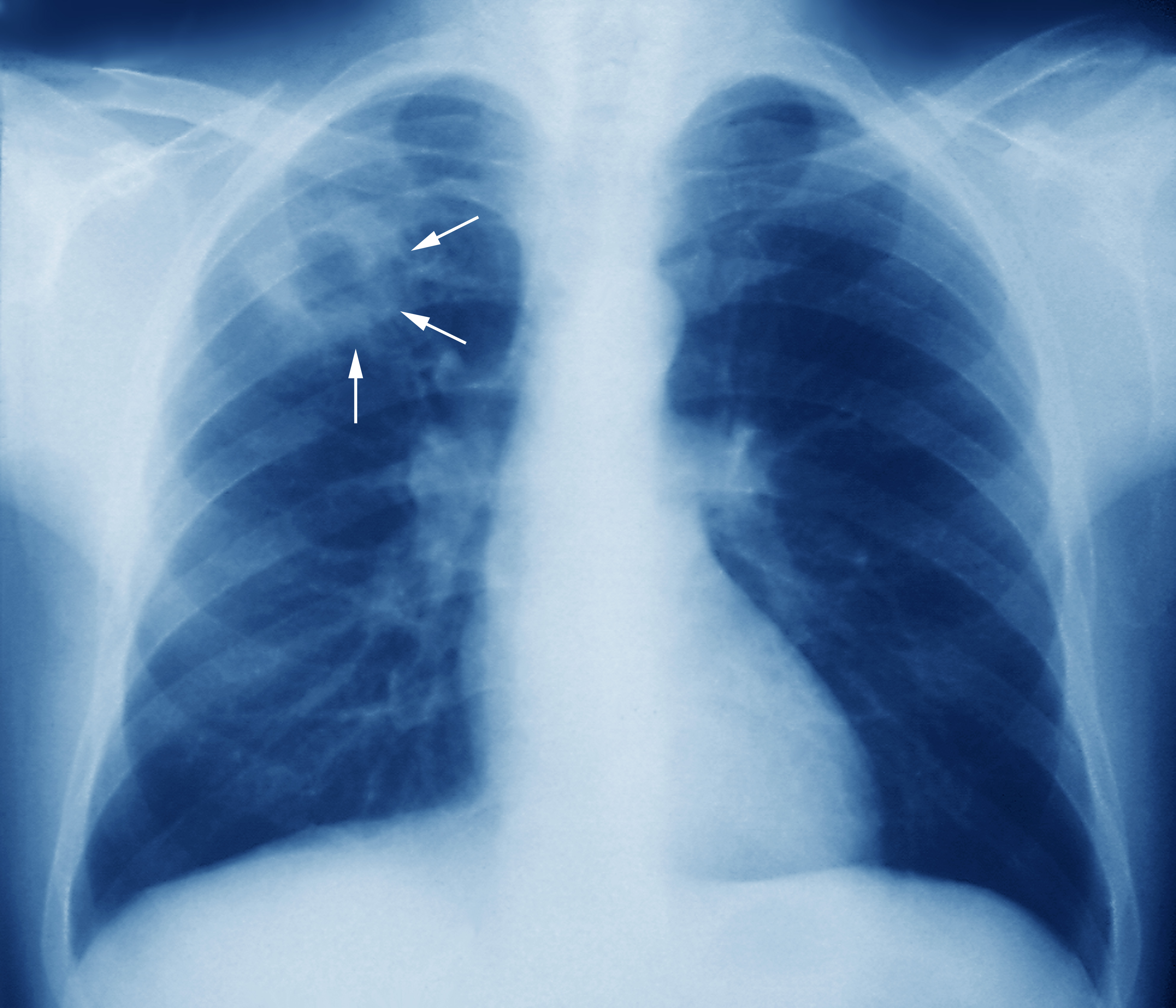 https://meddk.com/wp-content/uploads/2020/12/m2700245-tuberculosis-chest-x-ray-science-photo-library-high.jpg