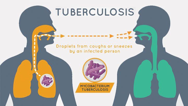 Tuberkulose: årsager, symptomer og behandling