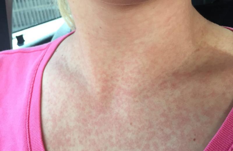Dengue feber udslæt